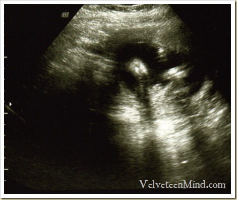 ultrasounds at 6 weeks. ultrasound-06-09-lumps